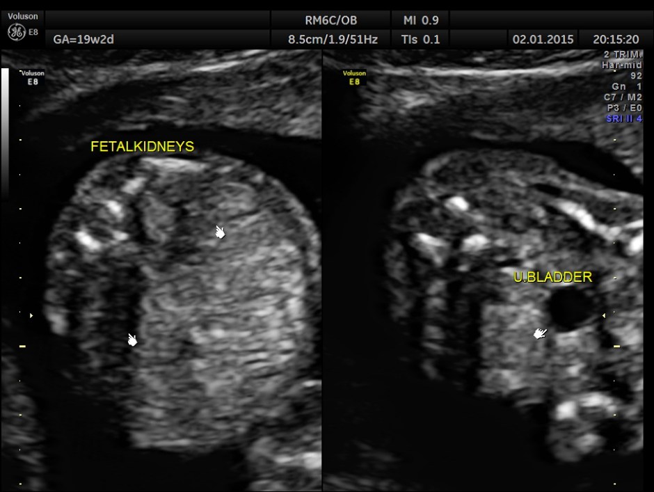 PERI EFF VSD LT HEART HYPO_18