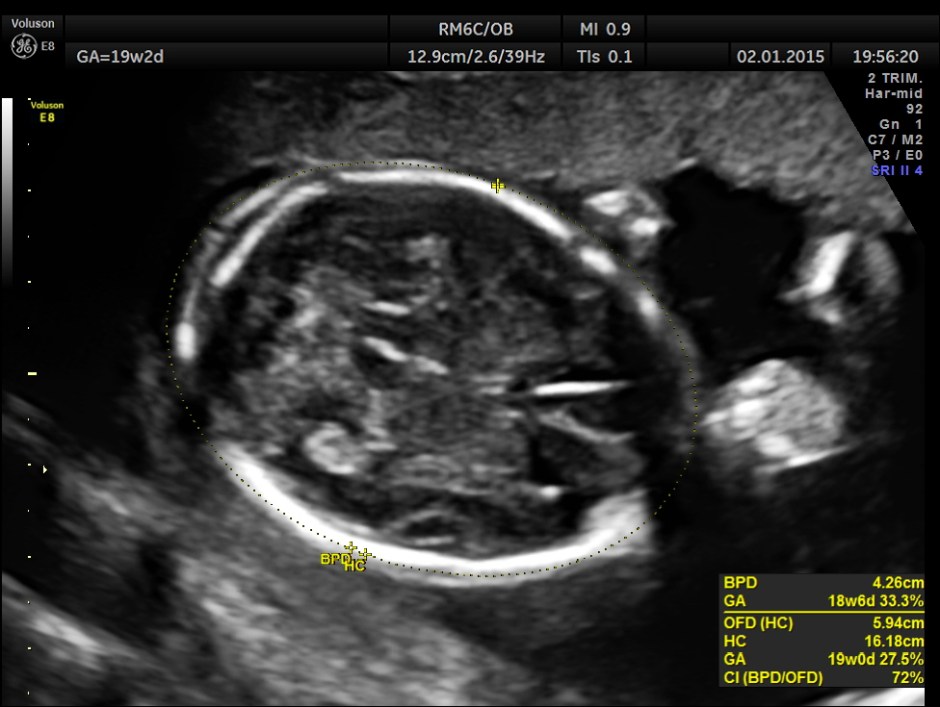 PERI EFF VSD LT HEART HYPO_2