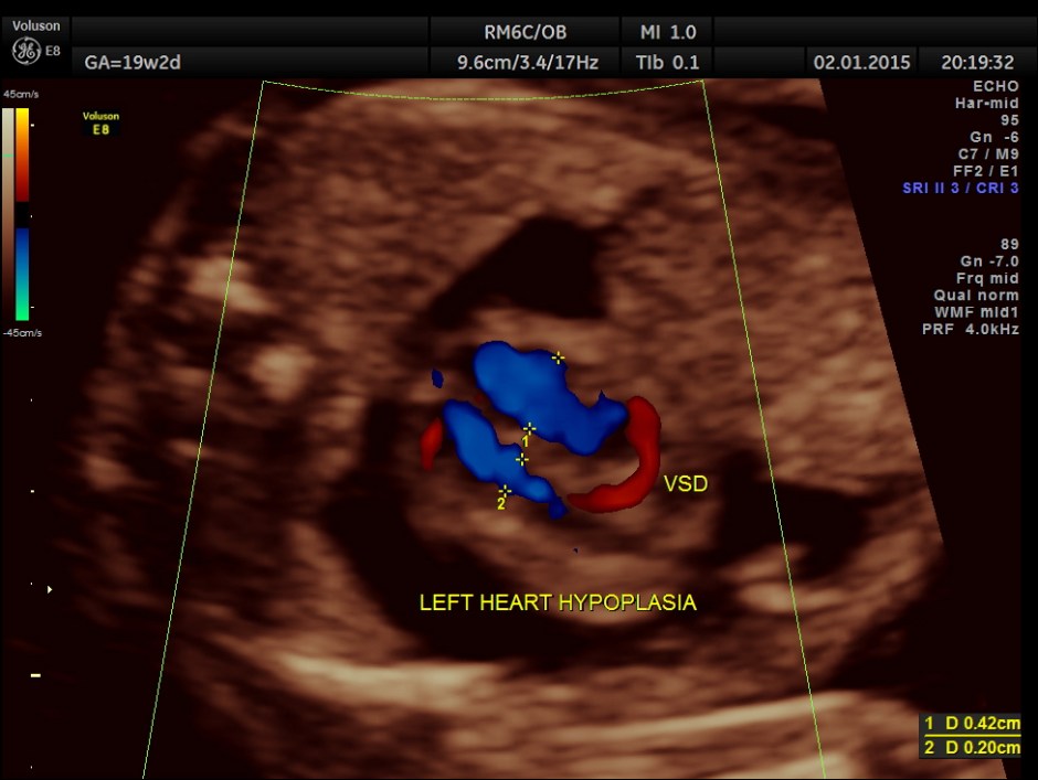 PERI EFF VSD LT HEART HYPO_20