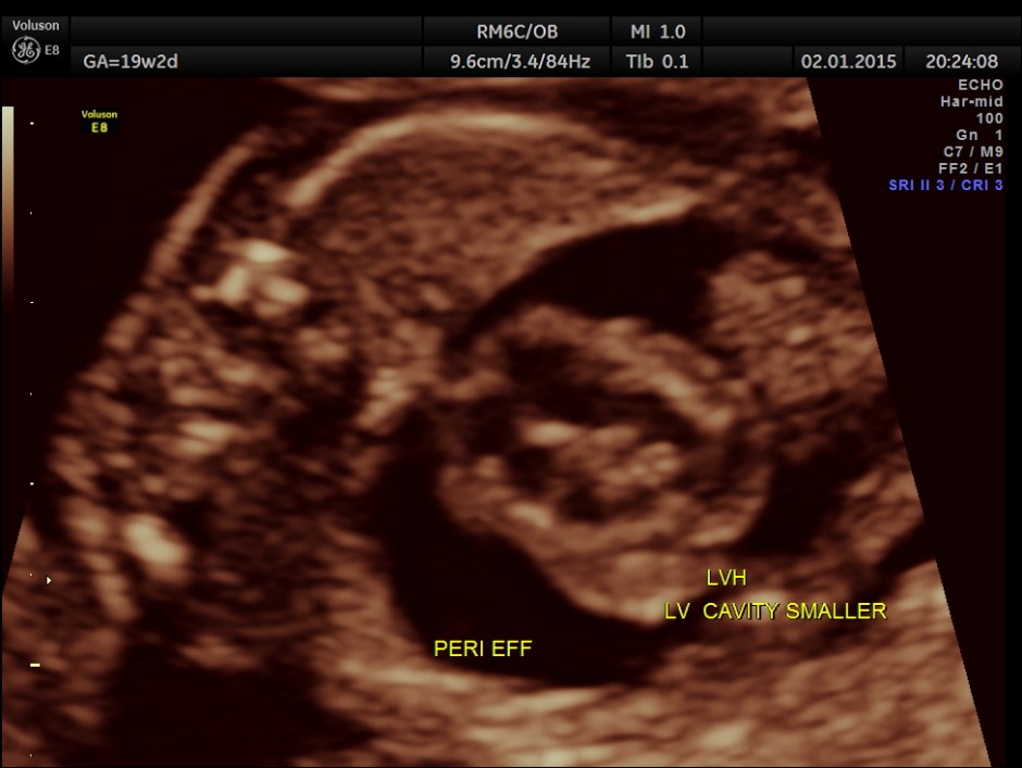 PERI EFF VSD LT HEART HYPO_24