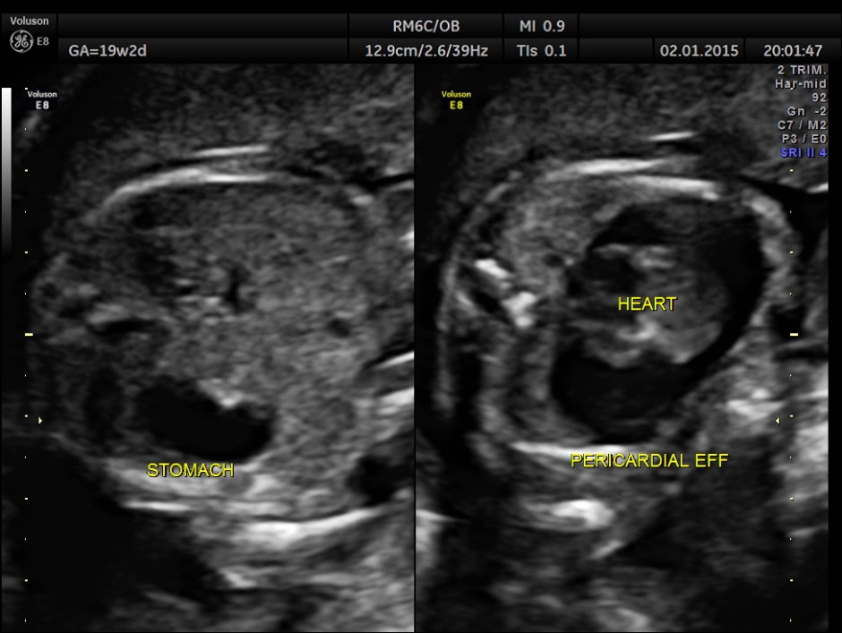 PERI EFF VSD LT HEART HYPO_7