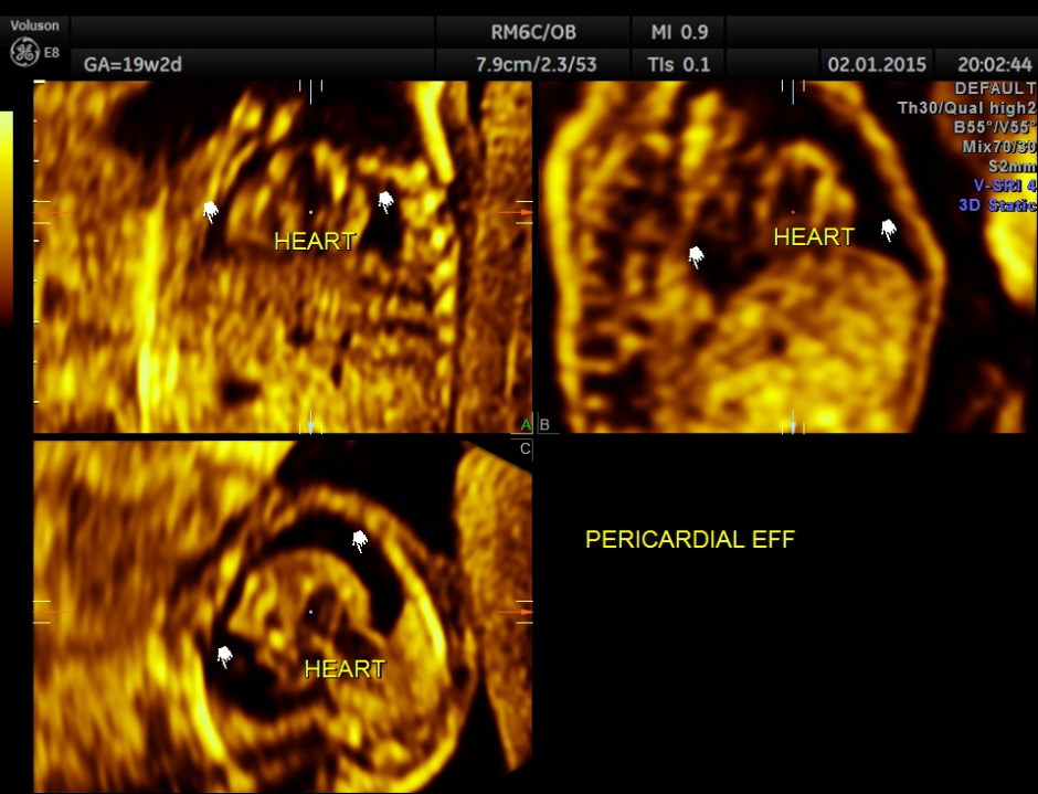PERI EFF VSD LT HEART HYPO_8