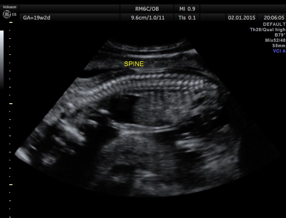 PERI EFF VSD LT HEART HYPO_9