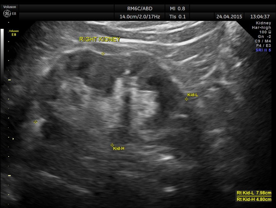 BLADDER MASS PELVIC MASS BPH_1