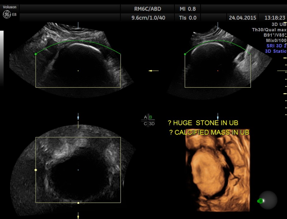 BLADDER MASS PELVIC MASS BPH_10