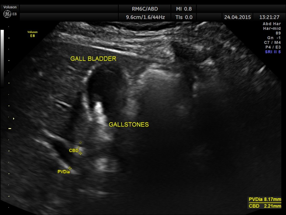 BLADDER MASS PELVIC MASS BPH_11