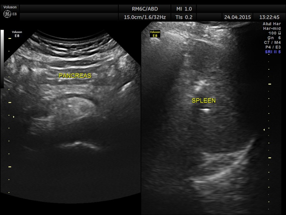 BLADDER MASS PELVIC MASS BPH_12