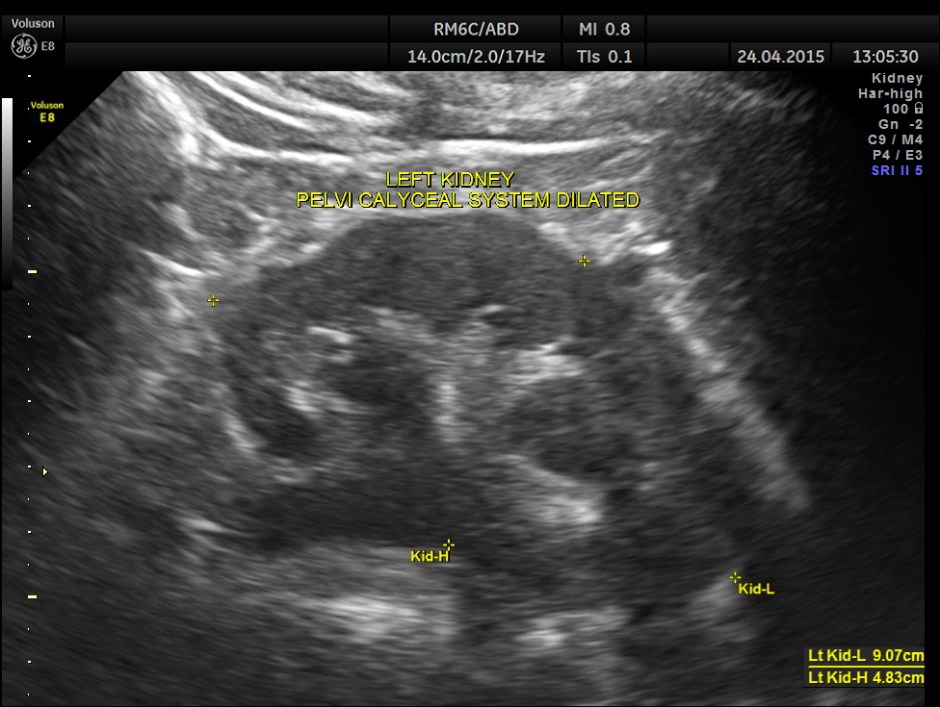 BLADDER MASS PELVIC MASS BPH_2