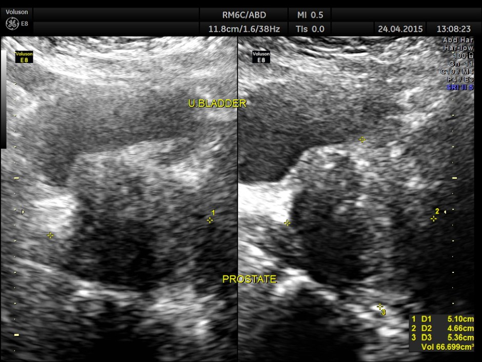 BLADDER MASS PELVIC MASS BPH_3