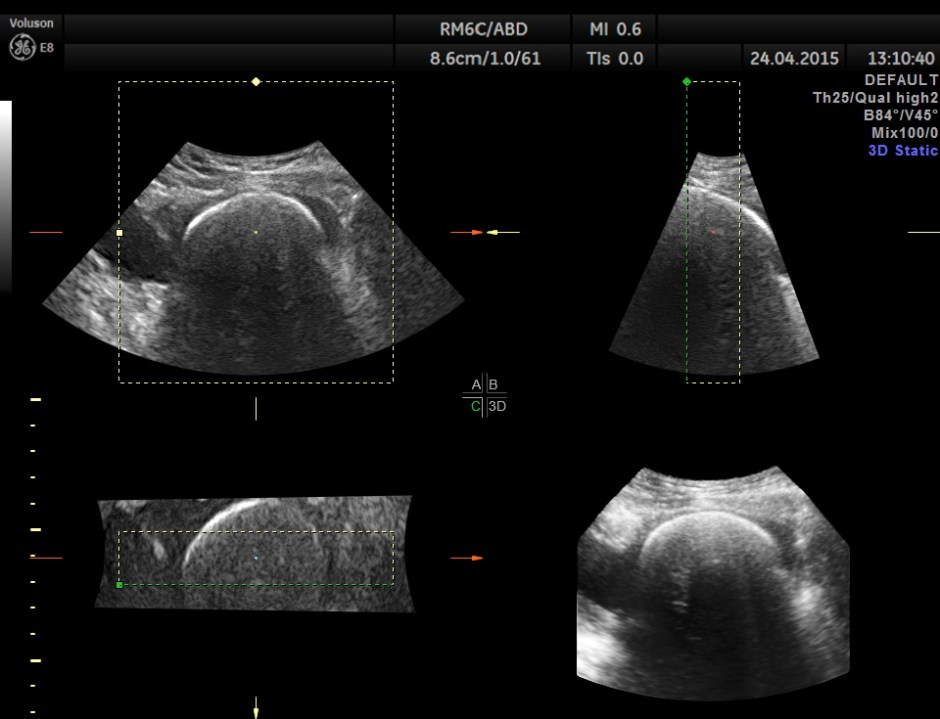 BLADDER MASS PELVIC MASS BPH_5
