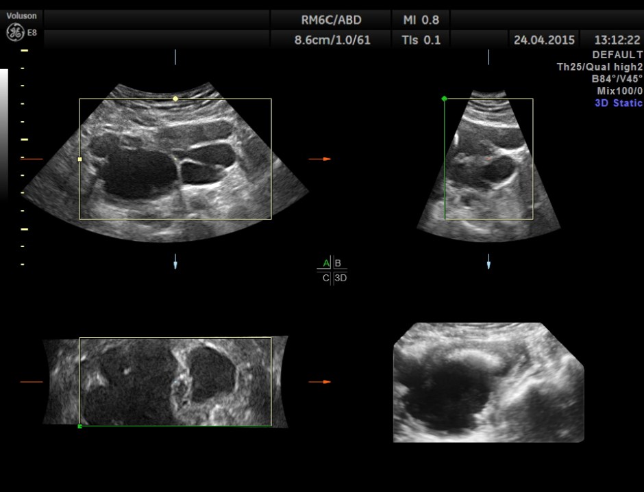 BLADDER MASS PELVIC MASS BPH_6