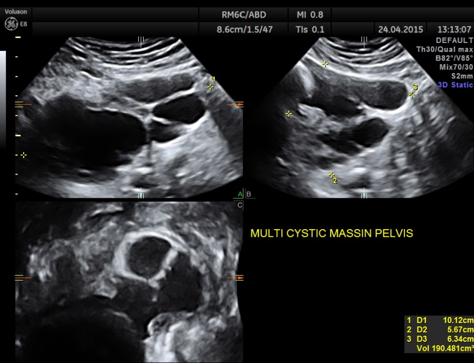 BLADDER MASS PELVIC MASS BPH_7