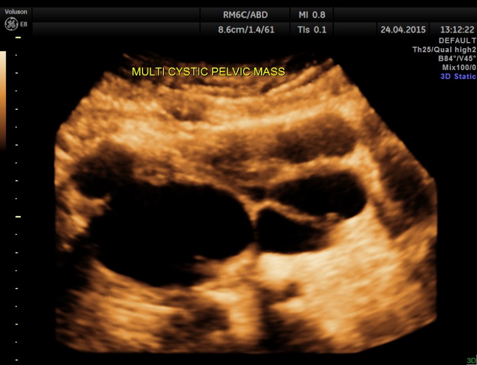 BLADDER MASS PELVIC MASS BPH_8