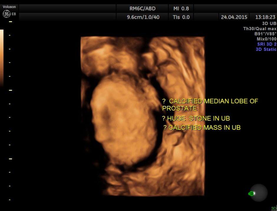 BLADDER MASS PELVIC MASS BPH_9