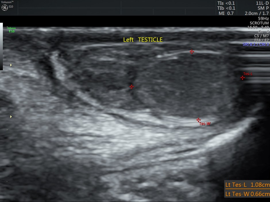 ENCYSTED HYDROCELE OFCORD_6