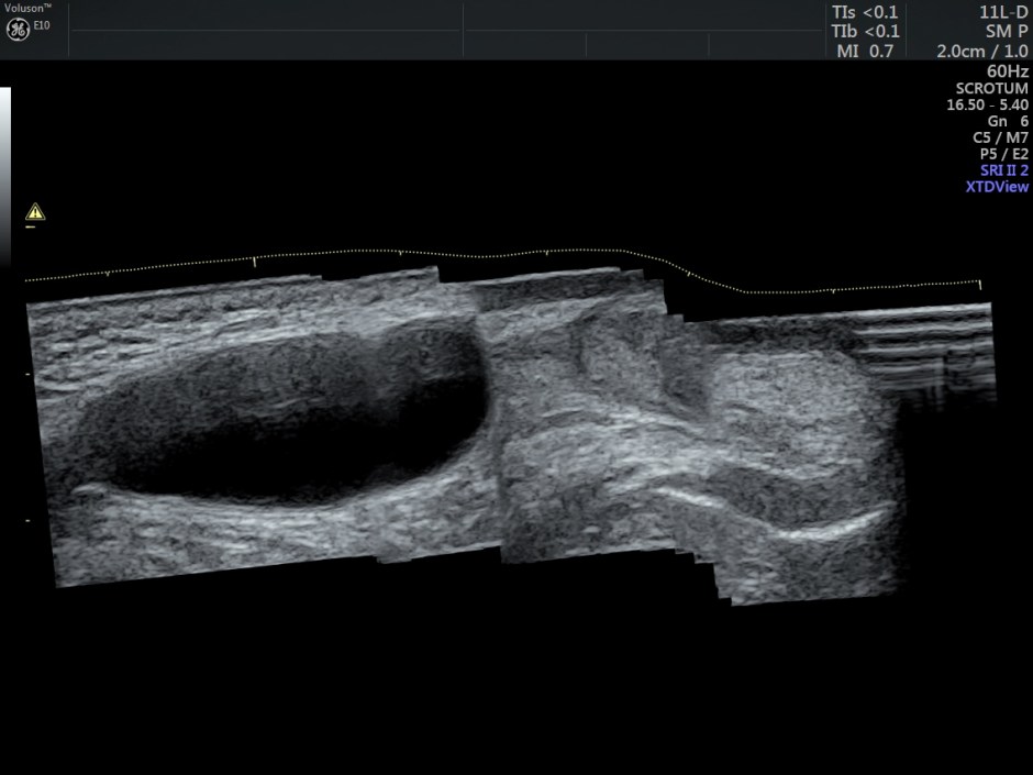 ENCYSTED HYDROCELE OFCORD_7