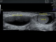 Hydrocele Ultrasound Ultrasound Case 068 LITFL POCUS