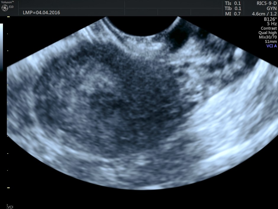 vascular malformation in uterus_16