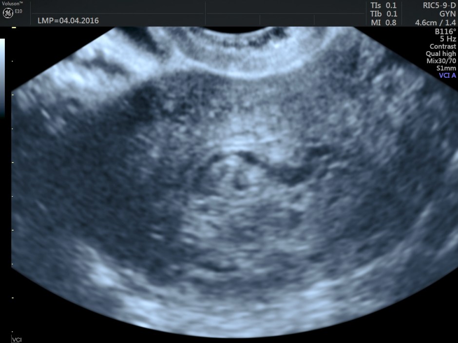 vascular malformation in uterus_28