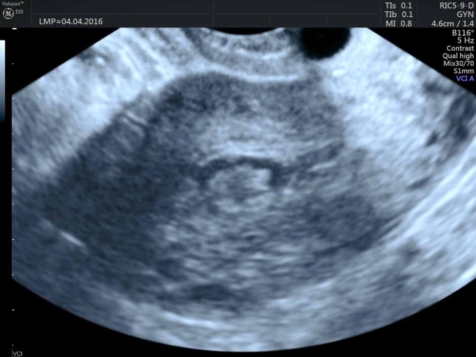 vascular malformation in uterus_29