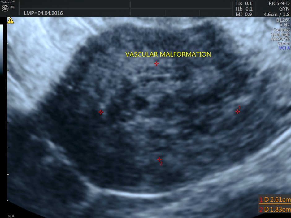 vascular malformation in uterus_32