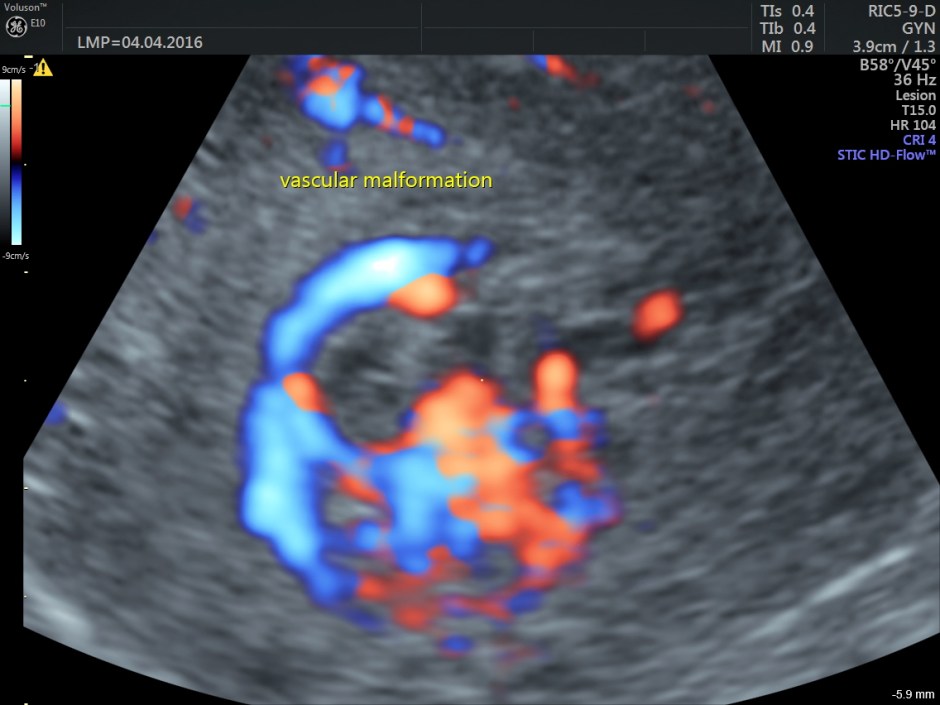 vascular malformation in uterus_34