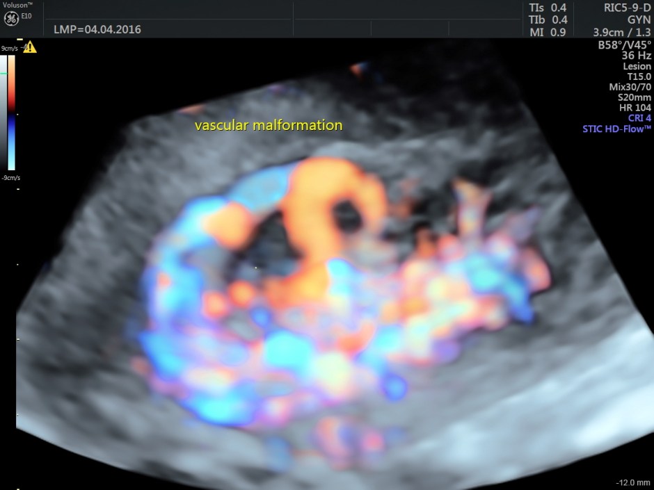 vascular malformation in uterus_35