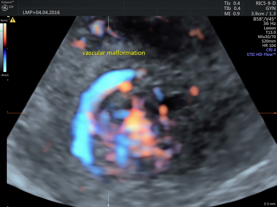 vascular malformation in uterus_36