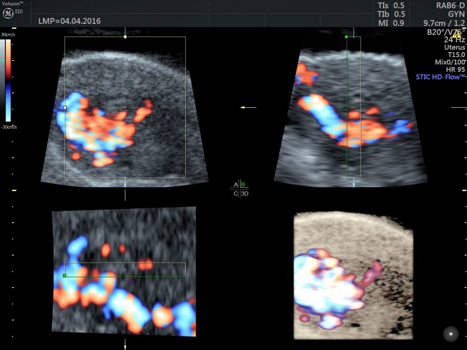 vascular malformation in uterus_6