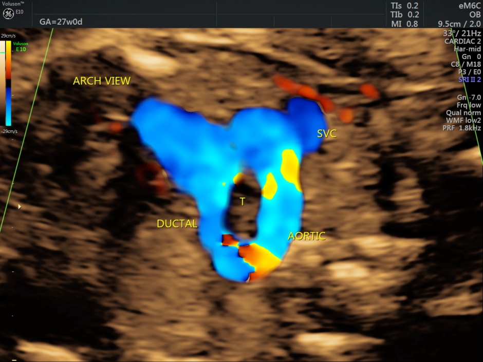 RT AORTIC ARCH_32