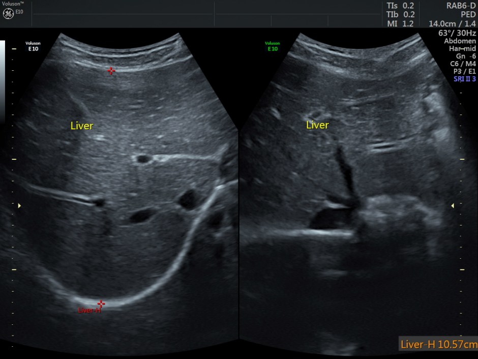 HEMOLYTIC ANEMIA CH SM_1