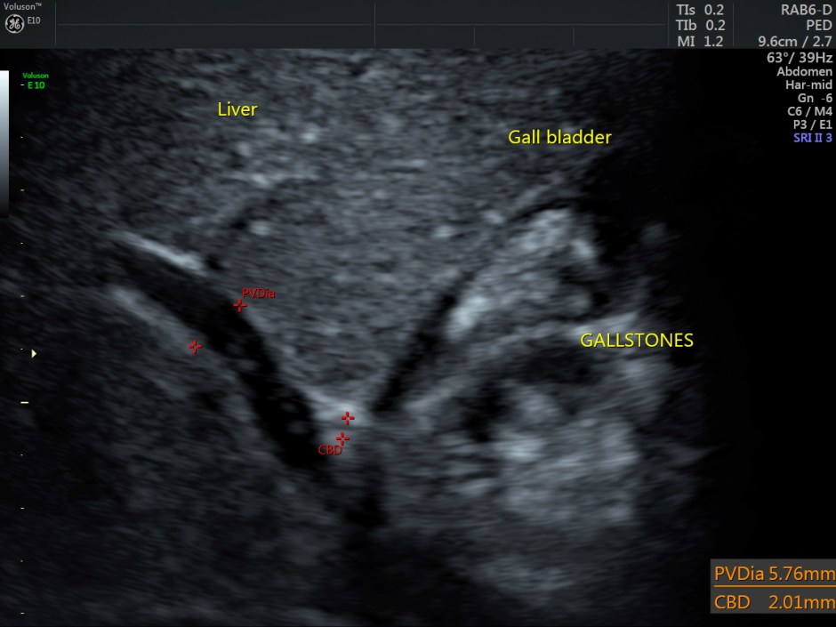 HEMOLYTIC ANEMIA CH SM_2