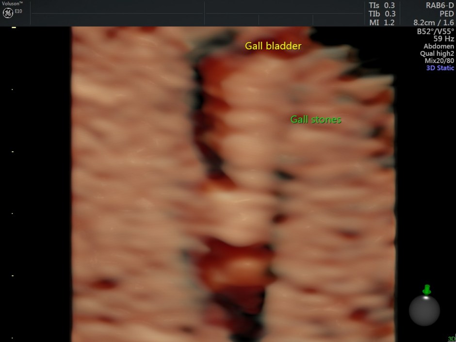 HEMOLYTIC ANEMIA CH SM_3