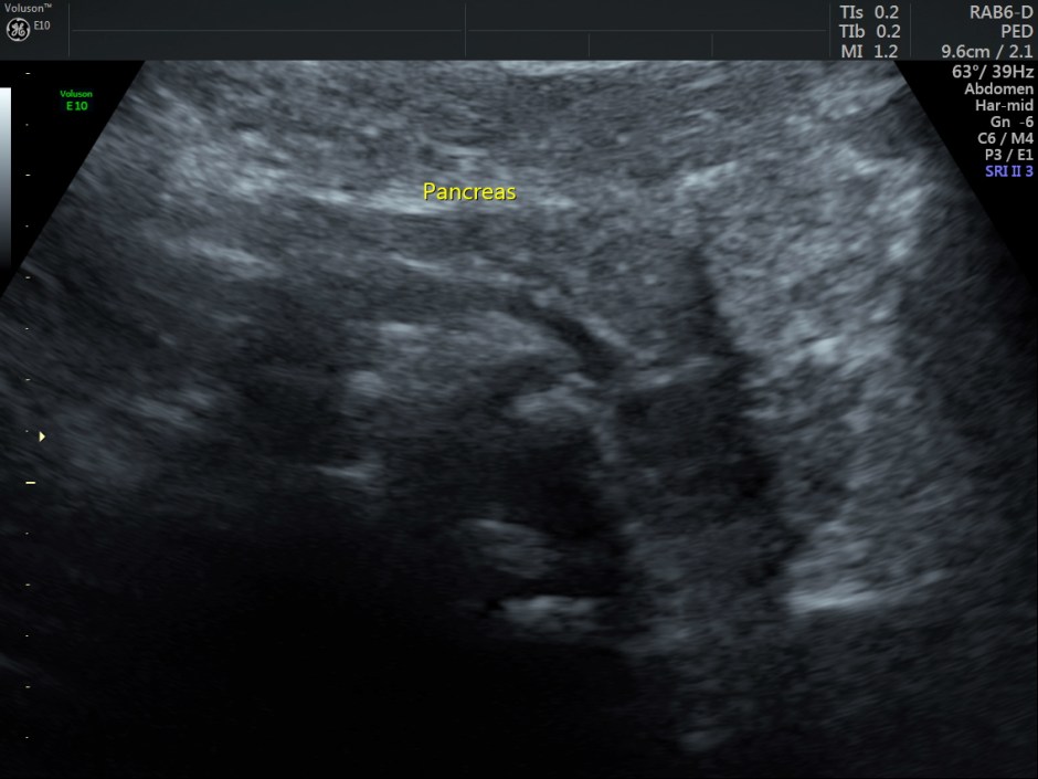 HEMOLYTIC ANEMIA CH SM_4
