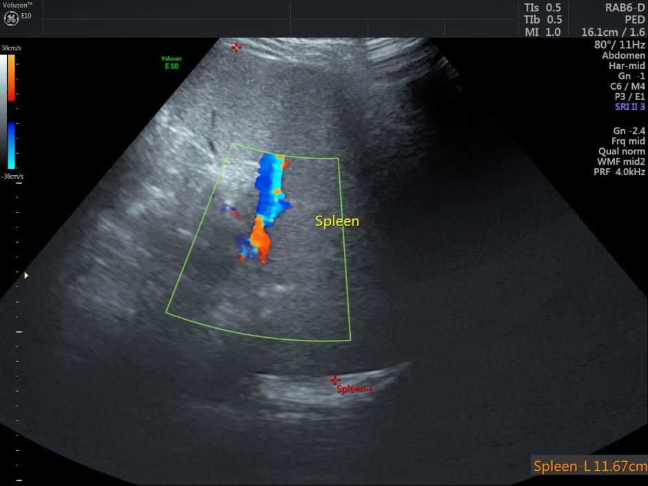 HEMOLYTIC ANEMIA CH SM_5