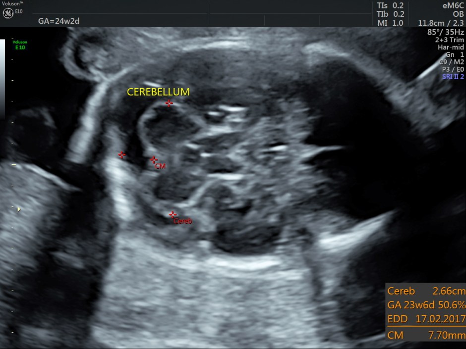 choroid plexus papilloma_1