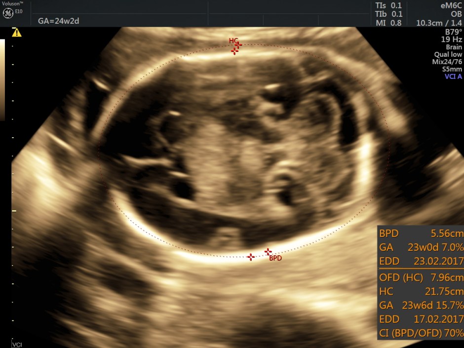 choroid plexus papilloma_16