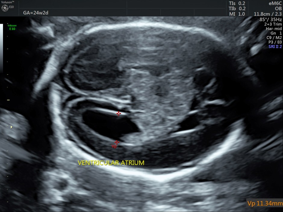 choroid plexus papilloma_2
