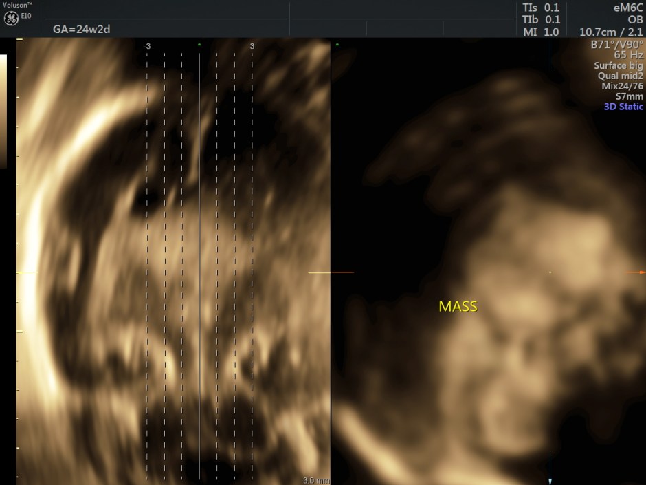 choroid plexus papilloma_39
