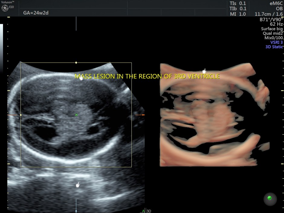 choroid plexus papilloma_44