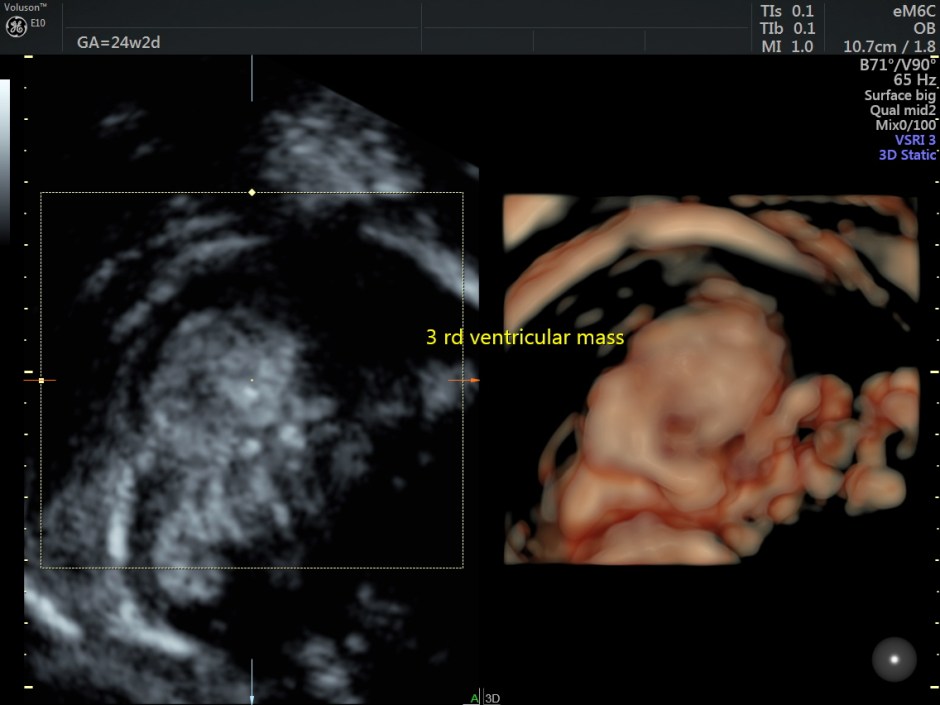 choroid plexus papilloma_47
