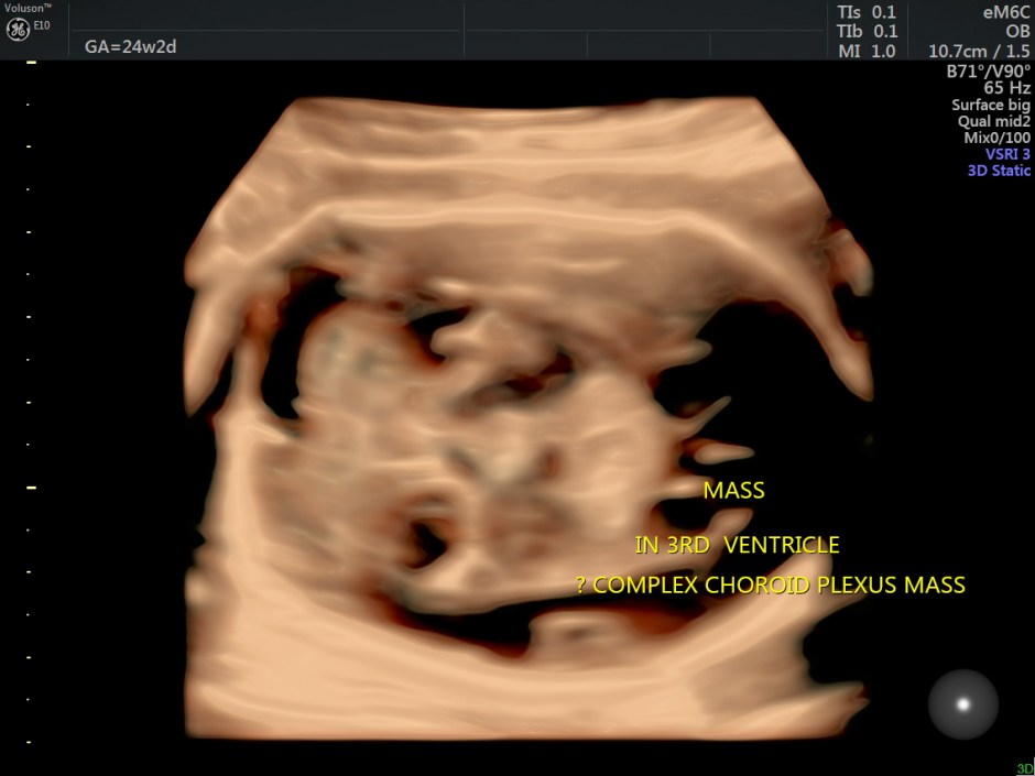 choroid plexus papilloma_50