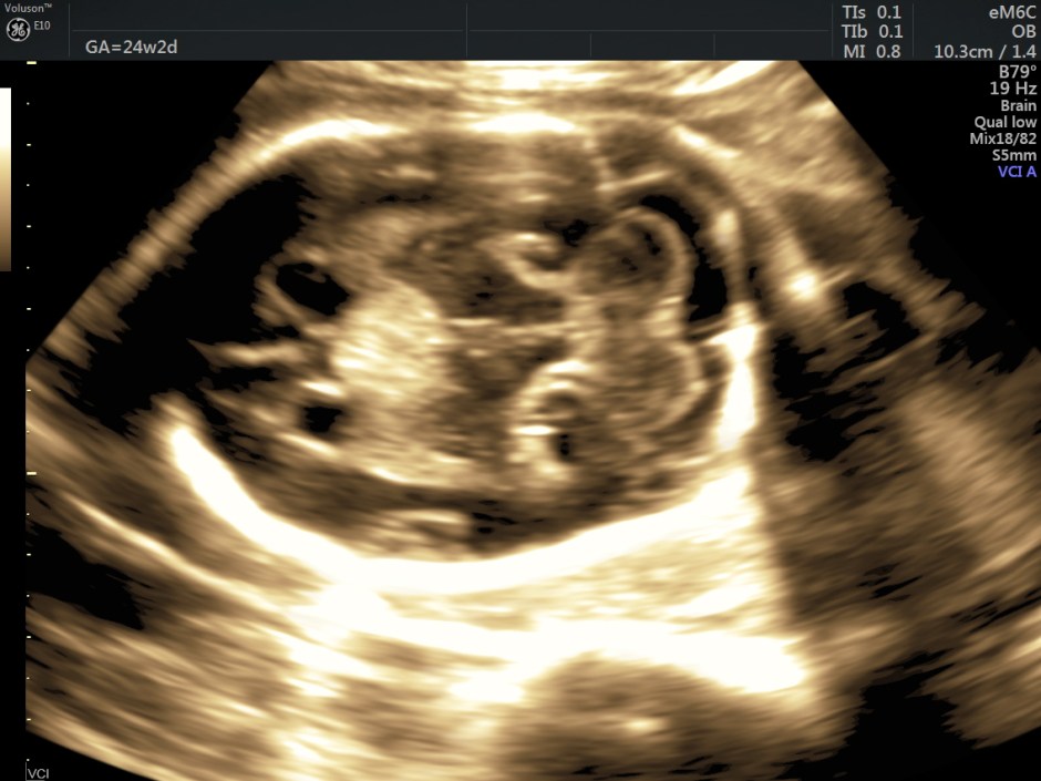 choroid plexus papilloma_51