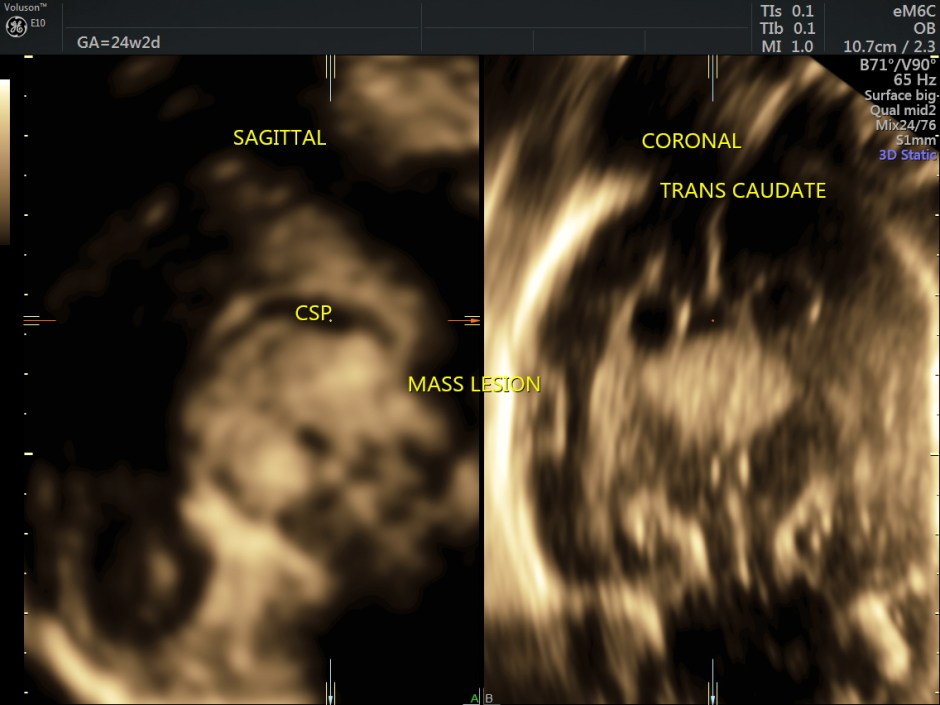 choroid plexus papilloma_6