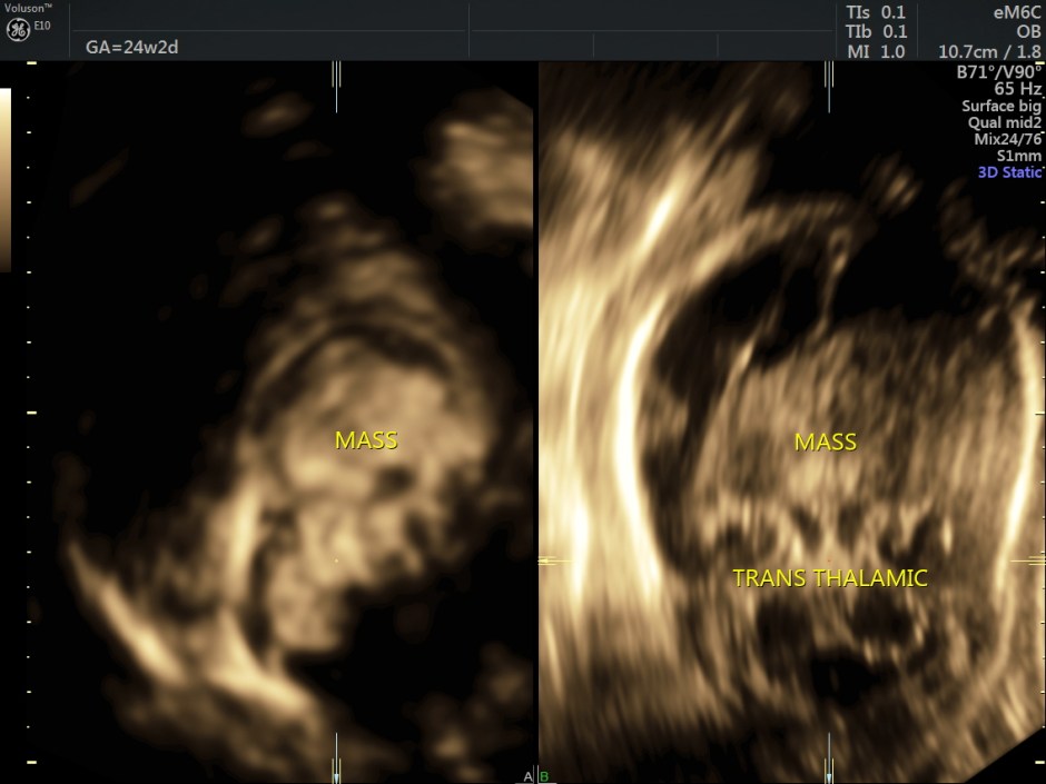 choroid plexus papilloma_9